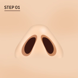 Step 1: Reduksi Lubang Hidung, jika Kulit pada ujung hidung tebal.