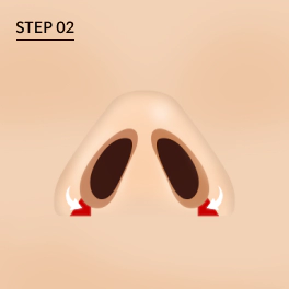 Step 2: Reduksi Lubang Hidung, jika Kulit pada ujung hidung tebal.