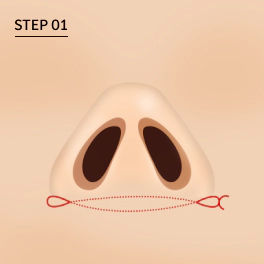 Step 1: Reduksi Lubang Hidung, jika Tulang rawan hidung terbuka lebar.