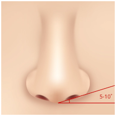 Rasio Ideal 3:Alar (cuping) hidung sebaiknya dinaikkan 5 hingga 10 derajat dari titik terbawah.