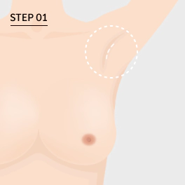 Operasi Revisi Bentuk Payudara Step 1