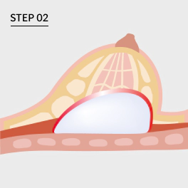 Operasi Revisi Bentuk Payudara Step 2