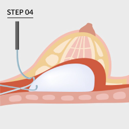 Operasi Revisi Bentuk Payudara Step 4
