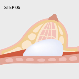 Operasi Revisi Bentuk Payudara Step 5