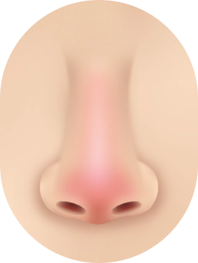 Kasus Revisi Bentuk Hidung : Terjadi reaksi peradangan.