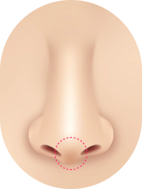 Kasus Revisi Bentuk Hidung : Ujung hidung terkulai.