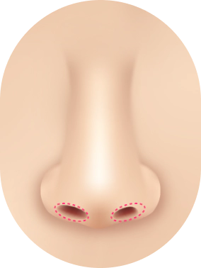 Kasus Revisi Bentuk Hidung : Ukuran lubang hidung asimetris.