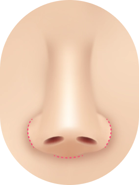 Kasus Revisi Bentuk Hidung : Hidung kembali ke bentuk semula.