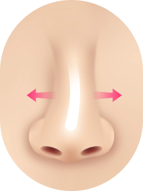 Kasus Revisi Bentuk Hidung : Prothesis dalam hidung bergerak.