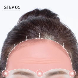 Seluruh area diseksi pada forehead lift.