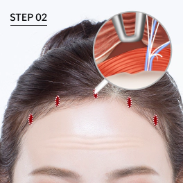 Bagian sayatan pada forehead lift endoskopi.