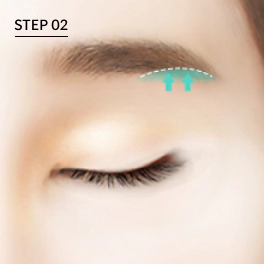 Bagian yang diangkat melalui sayatan sub-alis (sub-brow lift).