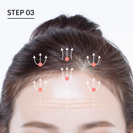 Arah fiksasi Endotine pada forehead lift endoskopi.