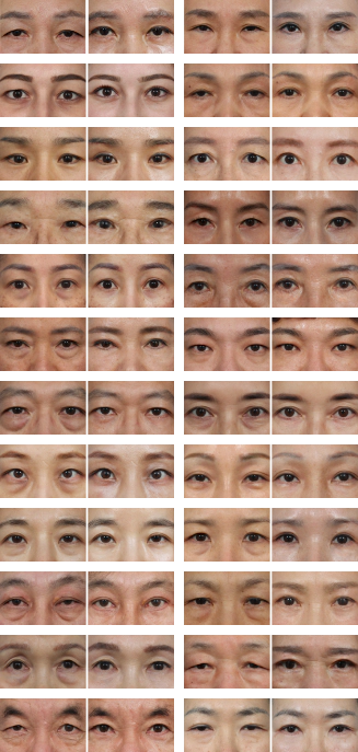Foto sebelum dan sesudah orang-orang yang tampak lebih muda setelah operasi kelopak mata atas dan bawah.