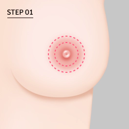Langkah 1:Sayatan di batas areola luar.