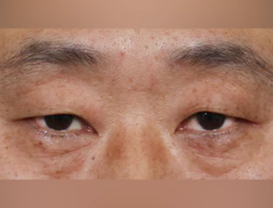 Metode Blepharoplasty Atas.