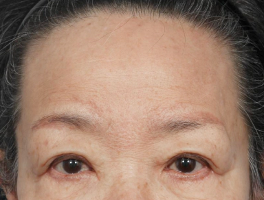Metode Forehead Lifting.