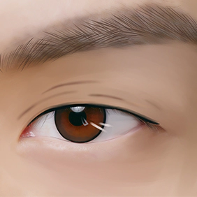 1 : Metode Bedah Sub-brow Lifting Kelopak Mata Pria MINE.
