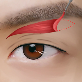 2 : Metode Bedah Sub-brow Lifting Kelopak Mata Pria MINE.