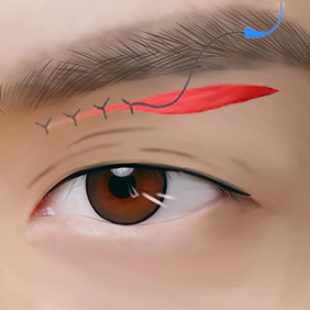 3 : Metode Bedah Sub-brow Lifting Kelopak Mata Pria MINE.