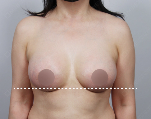 Operasi Payudara Kendur (Sesudah) Tahap 1.