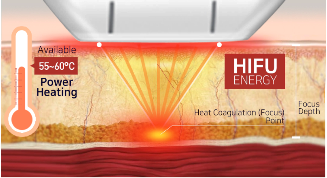 Menggunakan energi ultrasonik (HIFU), ia bekerja pada lapisan kulit dermal dan lapisan SMAS, menyebabkan kontraksi kulit dan efek pengangkatan.