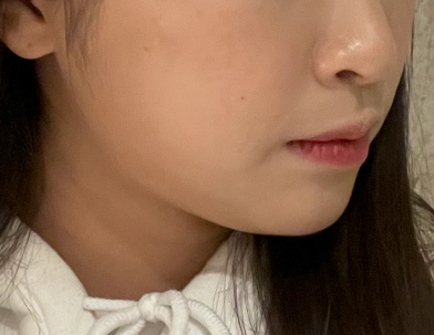 Garis Tebal dan Kusam Sebelum Melakukan Perawatan Botox.