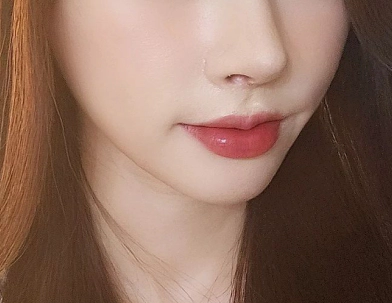 Setelah Perawatan Botox, Kerutan Halus Menghilang dan lebih Ramping,