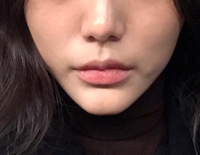 Gambar Sebelum Botox.