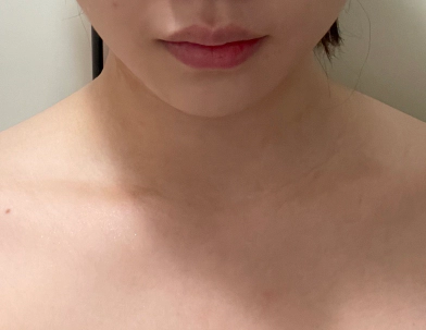 Gambar Sebelum Botox.