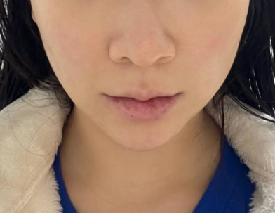 Wajah sebelum menerima perawatan filler Smile Line untuk volume wajah yang hilang.