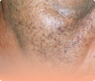 Ota nevus terjadi di banyak area wajah.