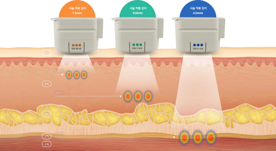 Ulthera, lifting premium yang menghantarkan panas ultrasound terfokus ke dermis dan SMAS tanpa merusak permukaan kulit.