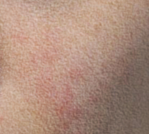 Sebelum Perawatan Stem cell Exosome ,Sebum berlebih dan sel kulit mati.
