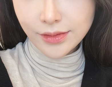 Sesudah Melakukan Perawatan Filler Design ,Contoh: Smile Line.