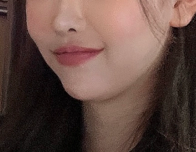 Wajah sebelum menerima perawatan filler Smile Line untuk volume wajah yang hilang.