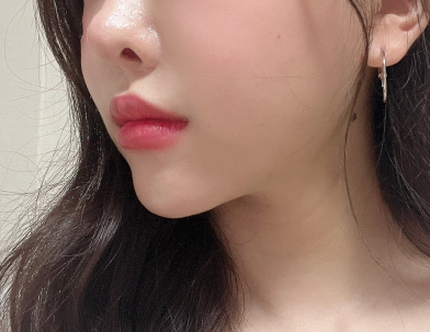 Seorang wanita yang mendapatkan garis halus melalui perawatan filler Smile Line di area cekung.