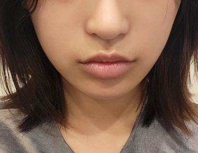 Wajah sebelum menerima perawatan filler Smile Line untuk volume wajah yang hilang.