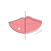 Pengisi bibir saya & koreksi botox sudut bibir asimetri dengan desain yang dipersonalisasi.