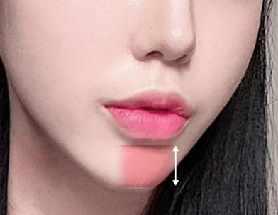 Sesudah Filler Bibir Mengisi volume bibir bawah akan membuat ujung dagu terlihat lebih pendek.