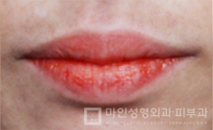 Sebelum Filler Bibir & Botox Sudut Bibir 06.