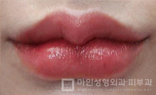 Sesudah Filler Bibir & Botox Sudut Bibir 06.