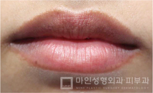 Sebelum Filler Bibir & Botox Sudut Bibir 07.