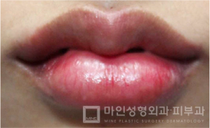 Sesudah Filler Bibir & Botox Sudut Bibir 07.