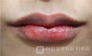 Sesudah Filler Bibir & Botox Sudut Bibir 01.