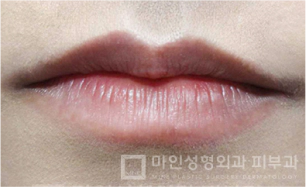 Sebelum Filler Bibir & Botox Sudut Bibir 03.