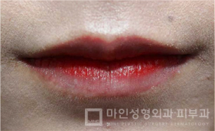 Sebelum Filler Bibir & Botox Sudut Bibir 04.