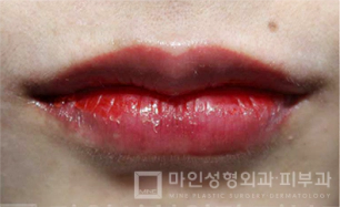 Sesudah Filler Bibir & Botox Sudut Bibir 04.