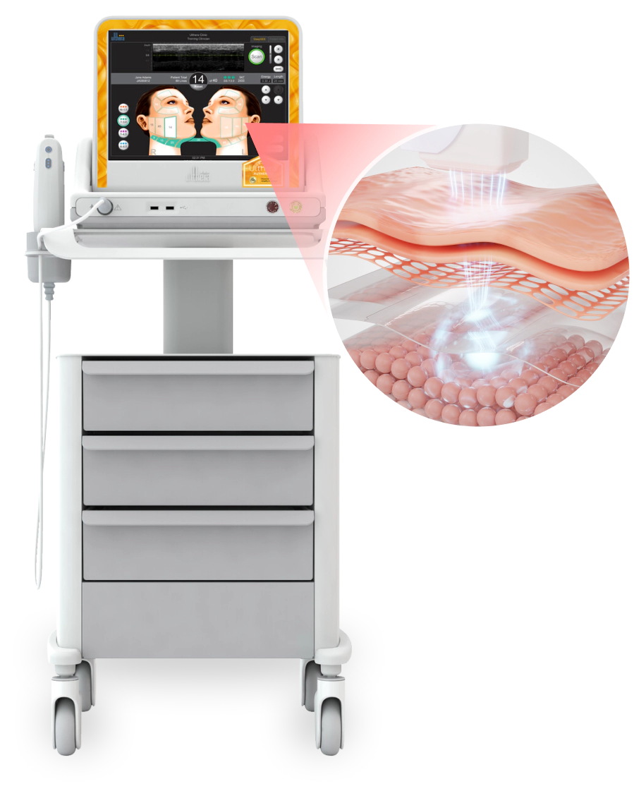 Alat Perangkat Laser Wajah Ulthera yang menjelaskan cara kerja facelift.
