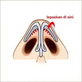 Operasi Revisi Hidung Pria, lubang hidung tidak rekat
